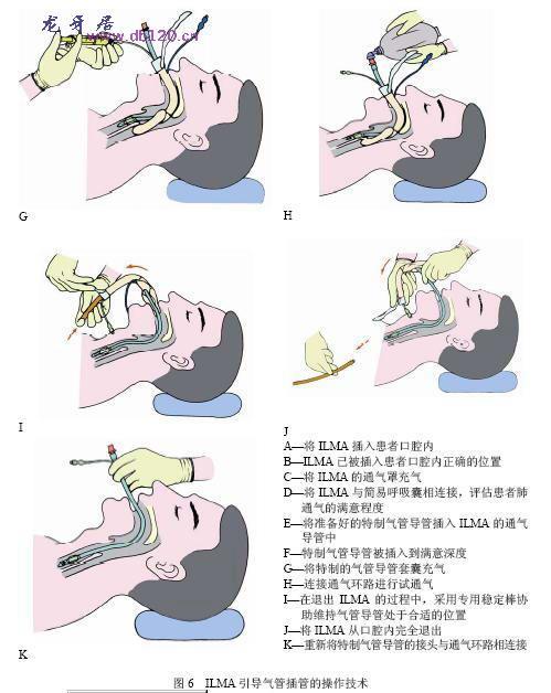 气管插管操作过程及关键技巧解析最新视频教程